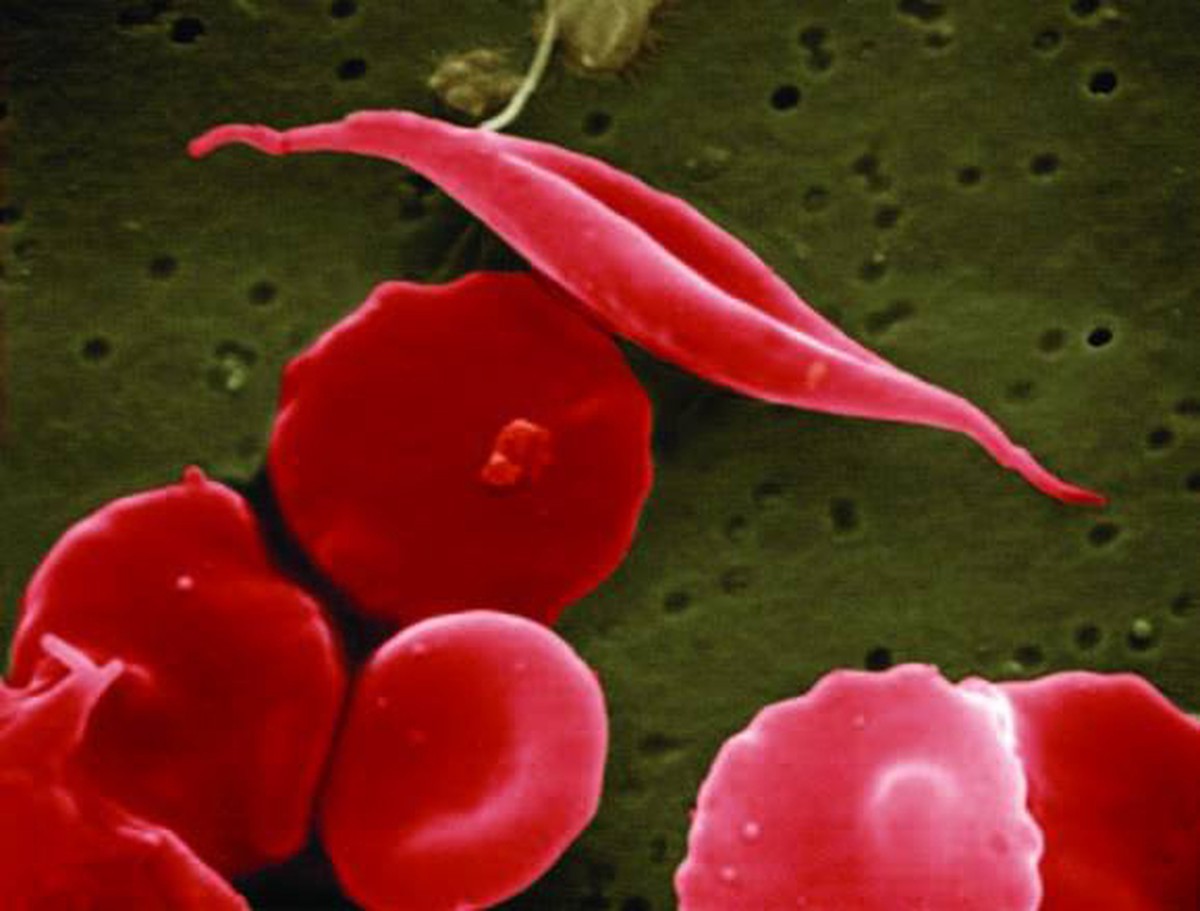 Brasil estuda terapia gênica inovadora contra anemia falciforme para incorporar ao SUS